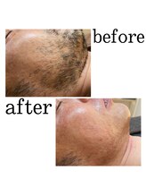 フェザー(feather)/シュガーリング脱毛