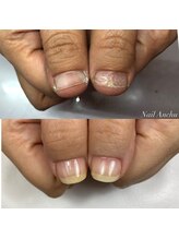ネイル アンチュ(Nail Anchu)/自爪育成／トラブルネイル