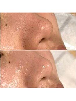 サロン ド ブラン アオヤマ(Salon de BLANC AOYAMA)/クリスティーナハーブピーリング