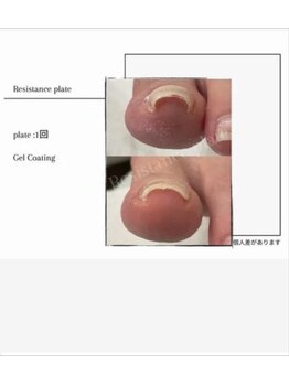 ルーチェネイル(LUCE .nail)の写真/巻き爪でお悩みの方におすすめ☆