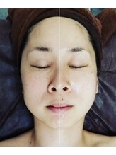 サロン シェリミー(Cheri mi)/光フェイシャル