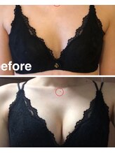 リール 新宿店(RIRE)/20代後半　バストアップ症例