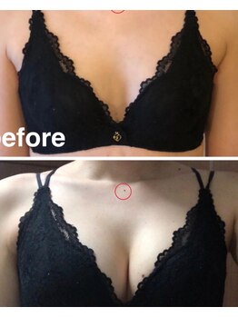 リール 新宿店(RIRE)/20代後半 バストアップ症例