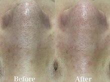 ヴィーヴ 京橋(vive)/【韓国式3D毛穴洗浄】