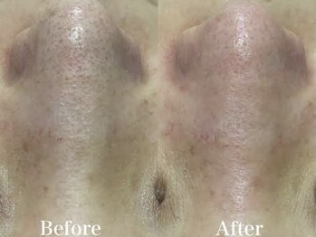 ヴィーヴ 京橋(vive)/【韓国式3D毛穴洗浄】