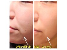 アン 銀座(ann)/レモンボトル2回目