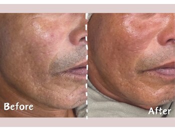 シー センター北(sii)/ララピール（施術回数３回）