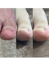 リリ(lili)/巻き爪矯正ビフォーアフター