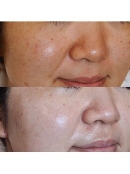 ザ シー タイムレスビューティ(THE SHE)/30代前半お客様症例写真