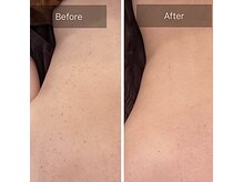 ルナート(Lunart)/ハーブピーリング【背中】