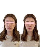 ニコディア(nico-dia)/美容鍼