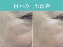 サロン ド ヒノキ(Salon de HINOKI)/しわ改善ハリ弾力UP