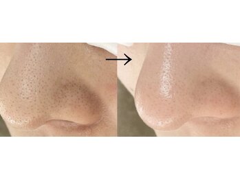 毛穴専科/毛穴洗浄+白玉ワックス メンズ◎