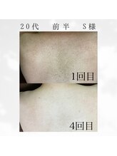 ナユタ(Nayuta)/綺麗な背中へ！メンズ背中脱毛！