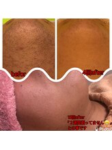 パーソナルエステティックサロン リボーン(ReBorn)/減っていくヒゲ＼(^o^)／