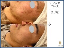 ひかり素肌/ハイケアコース 3か月