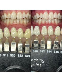 トウキョースワーズ 渋谷店(TOKYO SWRS)/#ホワイトニング #渋谷 #池袋