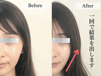 アライメント 自由が丘(Alignment)/施術例（小顔矯正）
