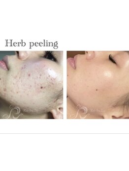 毛穴ケアをしたい