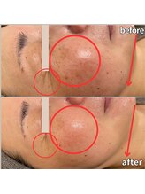 モーイエンチャーム(mooi en charme)/生ヒト幹細胞高濃度導入エステ★