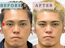 エルシンメトリー矯正院(ailesシンメトリー矯正院)/before＆after　ailes式小顔矯正
