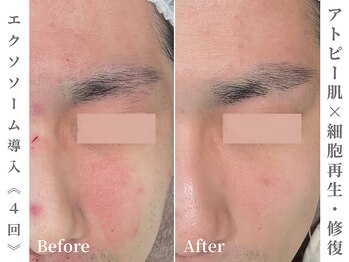 ゼアー(THERE FY.)/業界最高峰エクソソームをご用意