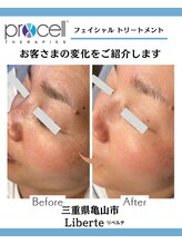 リベルテ(Liberte)/プロセルフェイシャル
