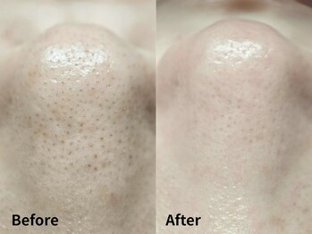 ルーチェ(LUCE)/毛穴洗浄Before→After
