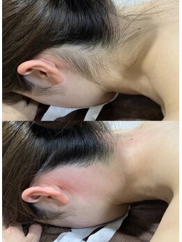 エレナビューティー(Elena Beauty)/うなじW脱毛