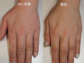 大人ネイル/加齢な手!ふっくら艶もちに☆