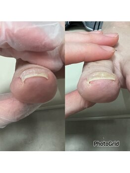 北区天神橋巻き爪センター/巻き爪