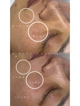 メルリー(Meruly)/サーマトリックス900shot