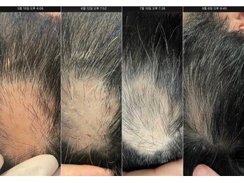 マーブル 熊本合志店/育毛促進【40代男性】