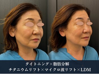 イロハ(IROHA)の写真/年齢を感じない若々しいお顔へ*年齢を重ねるたびに気になるお顔のたるみに!エステ以上の仕上がりをご提供♪