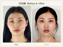 鍼灸院グロリアス 銀座(Glorious)の雰囲気(顔の歪み、リフトアップ、たるみを美容鍼で修正。/美容鍼/小顔)