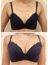 リール 新宿店(RIRE)/30代前半　バストアップ症例