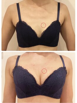 リール 新宿店(RIRE)/30代前半 バストアップ症例