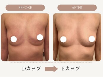 ウェルバスト(Well Bust)/【バストアップ例】D→Fカップ