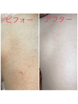 SDルーム/リベルハーブピーリング(背中)