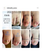 ナチュエイド/肥厚爪・変形爪ケア