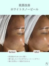 プラスワンビューティテン 新大阪店(Plus One Beauty)/肌質改善１回の変化