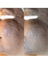 サロン フィオーレ(salon fiore)/毛穴、シミシワたるみ悩みに