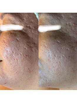 サロン フィオーレ(salon fiore)/毛穴、シミシワたるみ悩みに