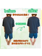 リコア(Re`core)/術後のビフォーアフター【骨盤】