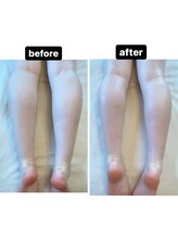 ルルン(LuLuN)/ラジオ波痩身ふくらはぎ