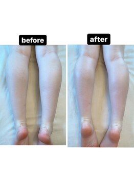 ルルン(LuLuN)/ラジオ波痩身ふくらはぎ