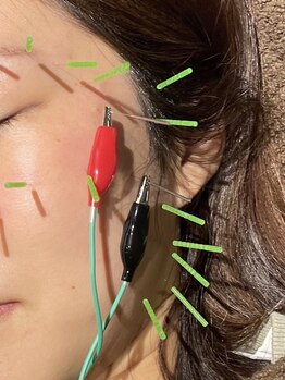 トキワ鍼灸接骨院ファースト(TOKIWA鍼灸接骨院1st)の写真/美容鍼で内面から輝く美しさへ!リフトアップ、小顔、しみしわ改善、ほうれい線やたるみケアにも◎