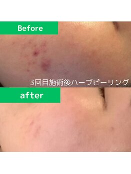 ティンクルホワイト 上尾店/ニキビケアハーブピーリング施術