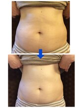 ディープブルー(Deep blue)/痩身キャビテーション