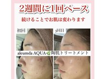 ホワイトアクア 天王寺本店(WHITE AQUA)/ハーブピーリング/大阪/天王寺